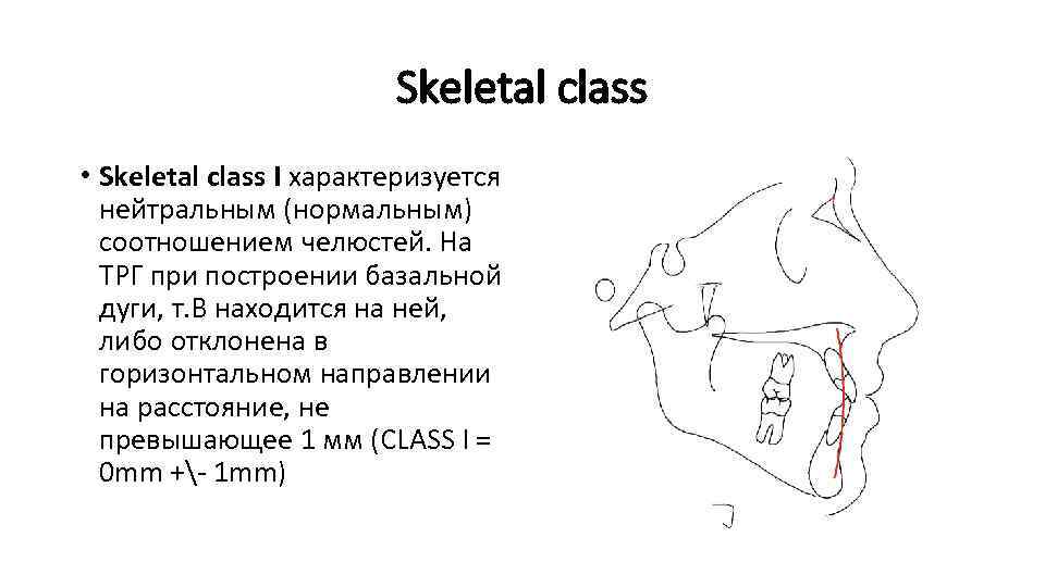 Skeletal class • Skeletal class I характеризуется нейтральным (нормальным) соотношением челюстей. На ТРГ при