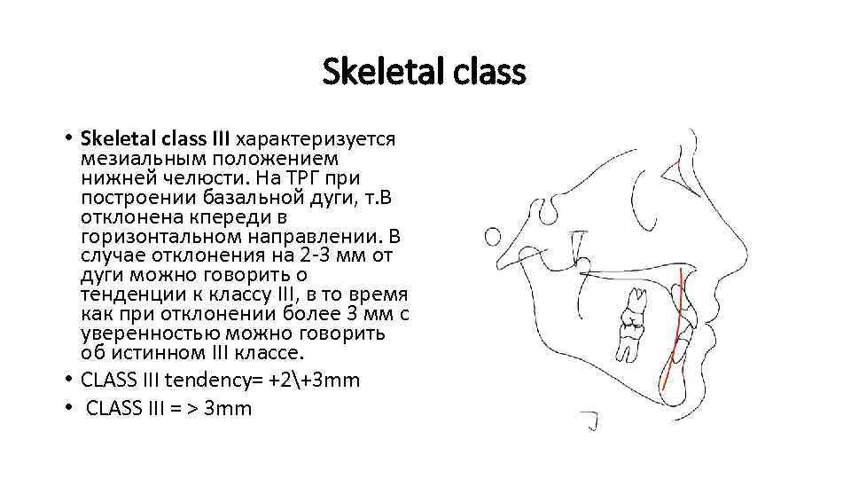 Skeletal class • Skeletal class III характеризуется мезиальным положением нижней челюсти. На ТРГ при