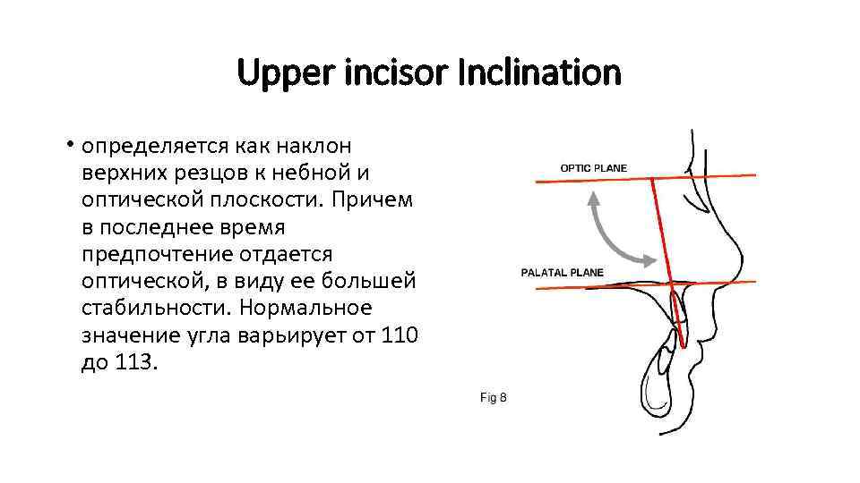 Upper incisor Inclination • определяется как наклон верхних резцов к небной и оптической плоскости.