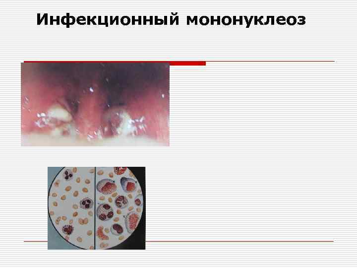 Инфекционный мононуклеоз 