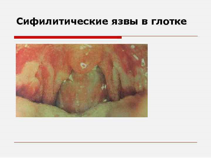 Сифилитические язвы в глотке 