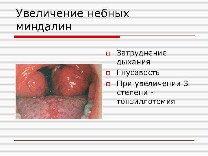 Увеличение небных миндалин o o o Затруднение дыхания Гнусавость При увеличении 3 степени тонзиллотомия