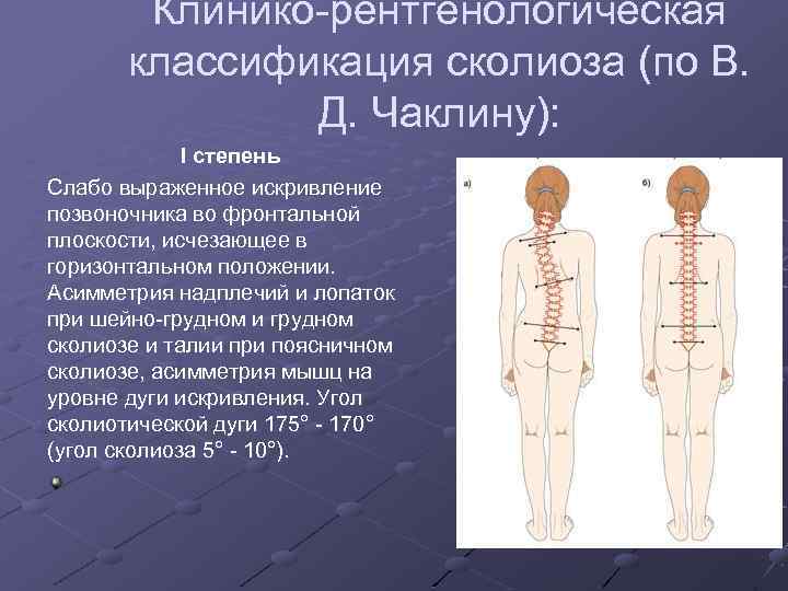 Искривление во фронтальной плоскости