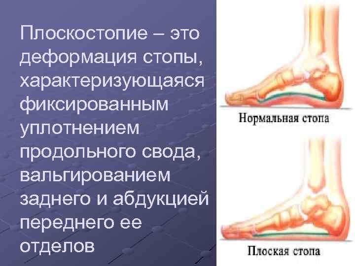 Плоскостопие – это деформация стопы, характеризующаяся фиксированным уплотнением продольного свода, вальгированием заднего и абдукцией