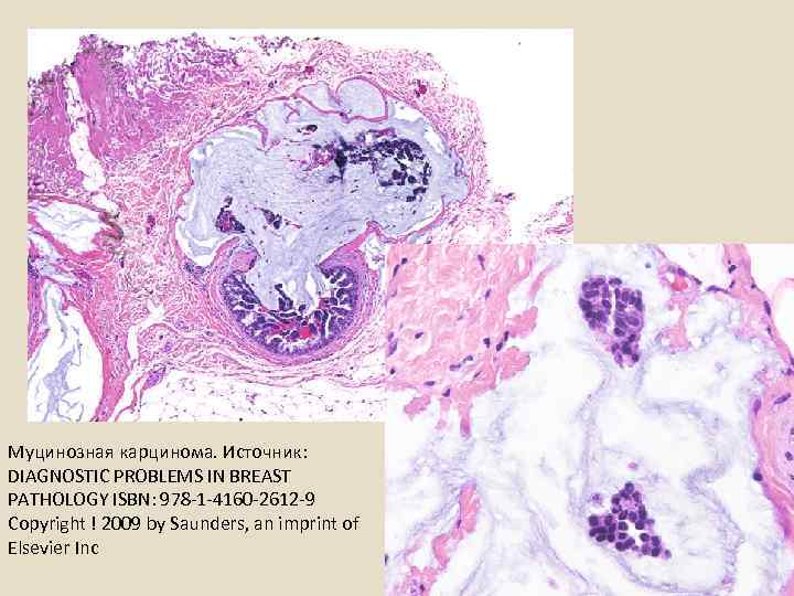 Муцинозная карцинома. Источник: DIAGNOSTIC PROBLEMS IN BREAST PATHOLOGY ISBN: 978 -1 -4160 -2612 -9