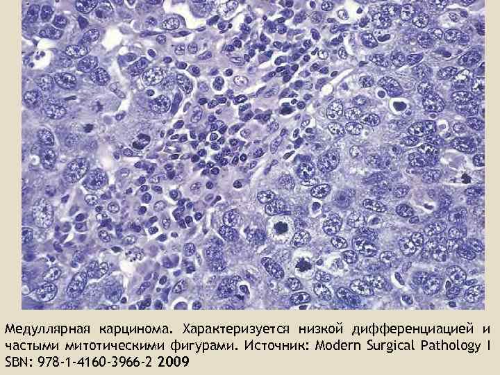 Медуллярная карцинома. Характеризуется низкой дифференциацией и частыми митотическими фигурами. Источник: Modern Surgical Pathology I