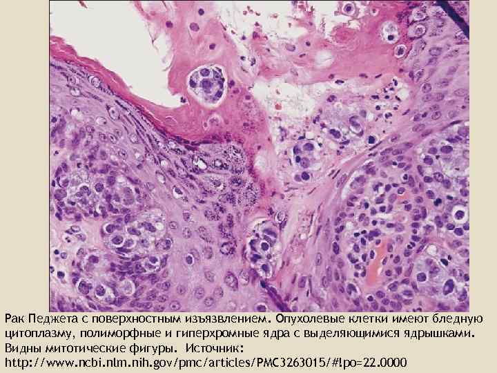 Рак педжета. Болезнь Педжета гистология. Болезнь Педжета молочной железы патанатомия. Опухоли молочной железы патанатомия. Клетки Педжета цитология.