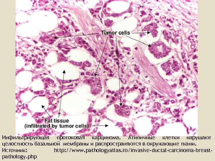 Протоковая карцинома молочной железы фото