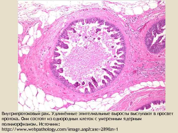 Внутрипротоковая карцинома in situ. Протоковая карцинома in situ. Опухоли молочной железы микропрепарат. Протоковая карцинома молочной железы гистология. Комедокарцинома гистология.