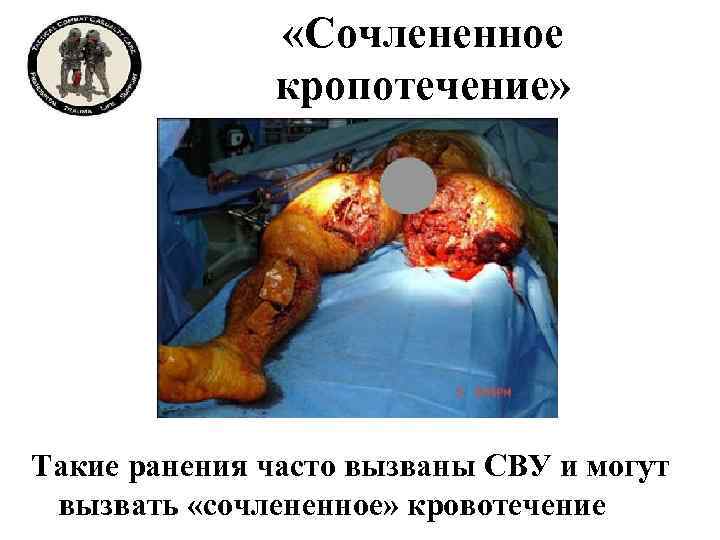  «Сочлененное кропотечение» Такие ранения часто вызваны СВУ и могут вызвать «сочлененное» кровотечение 
