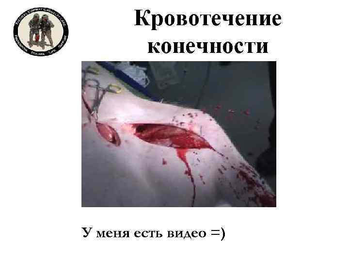 Кровотечение конечности У меня есть видео =) 