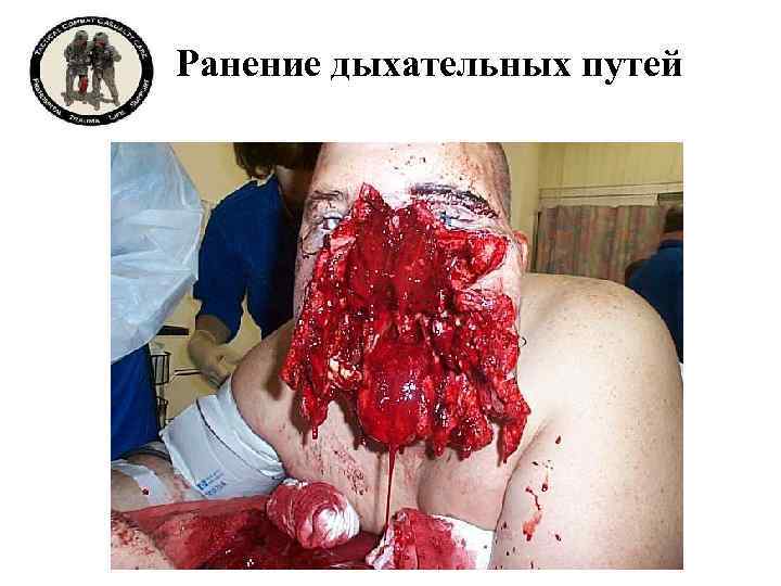Ранение дыхательных путей 