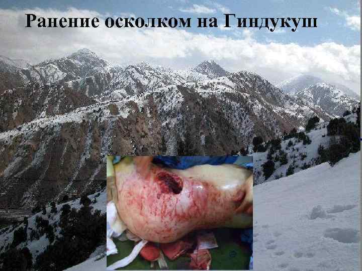 Ранение осколком на Гиндукуш Berator 