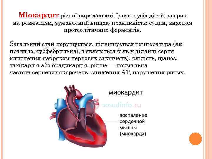 Міокардит різної вираженості буває в усіх дітей, хворих на ревматизм, зумовлений вищою проникністю судин,