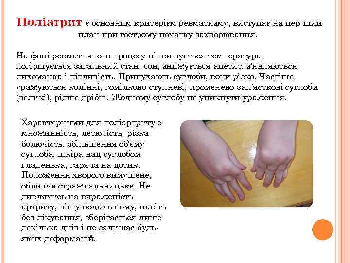 Поліатрит є основним критерієм ревматизму, виступає на пер ший план при гострому початку захворювання.