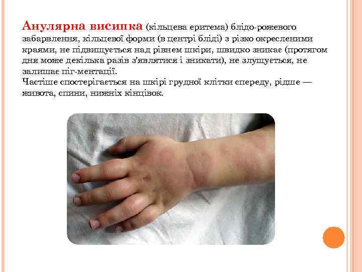 Анулярна висипка (кільцева еритема) блідо рожевого забарвлення, кільцевої форми (в центрі бліді) з різко