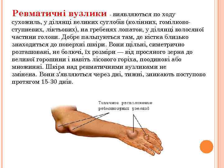 Ревматичні вузлики виявляються по ходу сухожиль, у ділянці великих суглобів (колінних, гомілково ступневих, ліктьових),