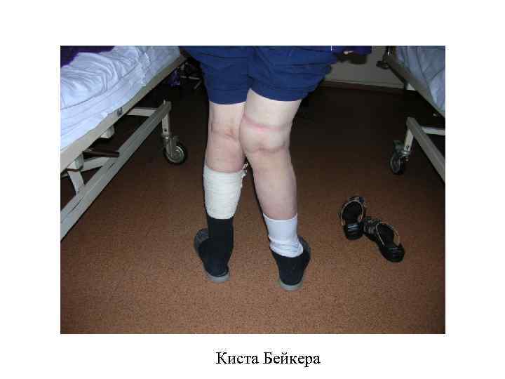 Киста Бейкера 