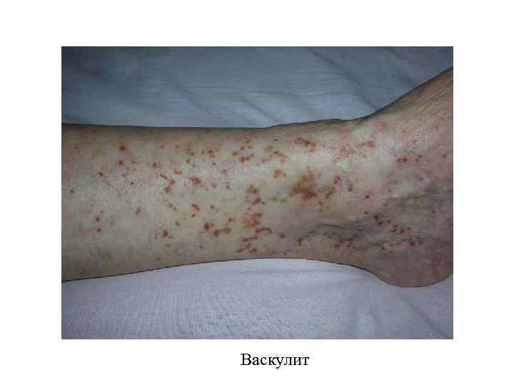 Васкулит 