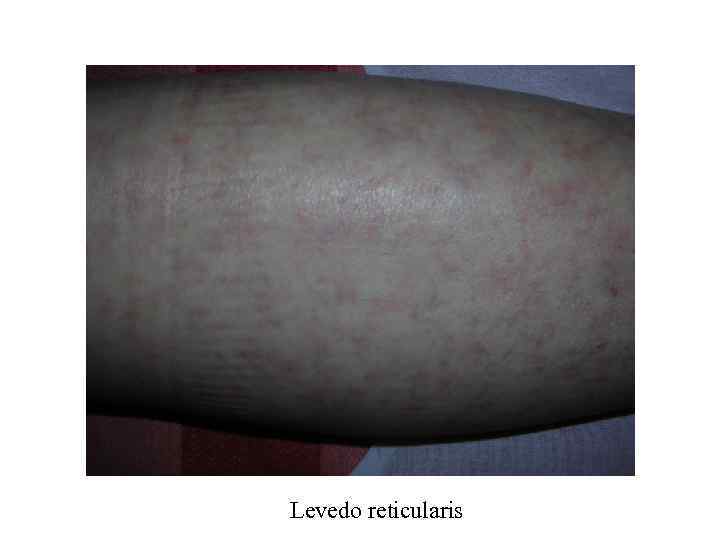 Levedo reticularis 