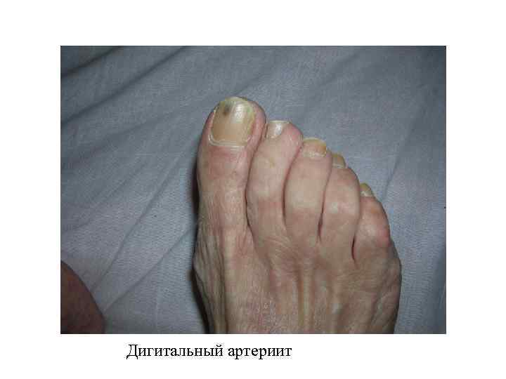 Дигитальный артериит 
