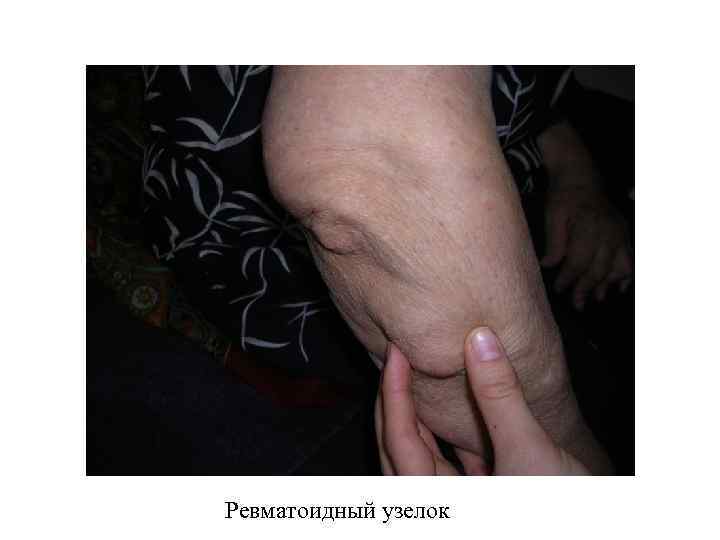 Ревматоидный узелок 