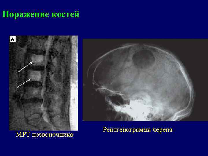 Поражение костей МРТ позвоночника Рентгенограмма черепа 
