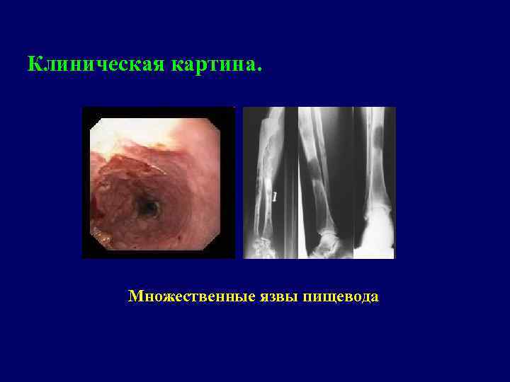 Клиническая картина. Множественные язвы пищевода 