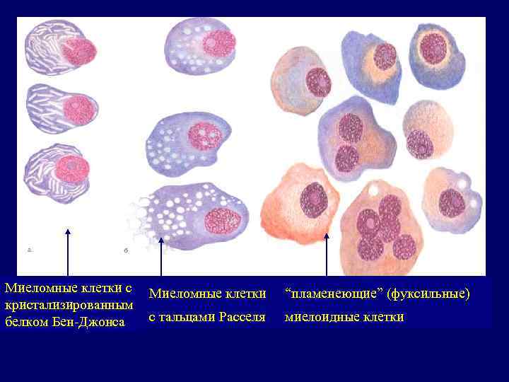 Миеломные клетки с кристализированным белком Бен-Джонса Миеломные клетки “пламенеющие” (фуксильные) с тальцами Расселя миелоидные