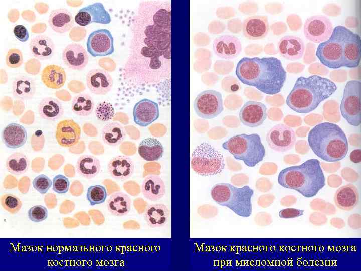 Мазок нормального красного костного мозга Мазок красного костного мозга при миеломной болезни 