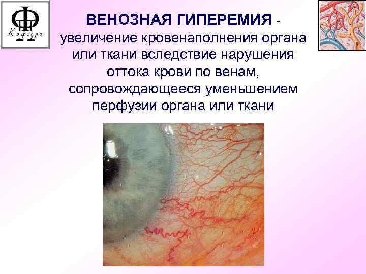 ВЕНОЗНАЯ ГИПЕРЕМИЯ увеличение кровенаполнения органа или ткани вследствие нарушения оттока крови по венам, сопровождающееся