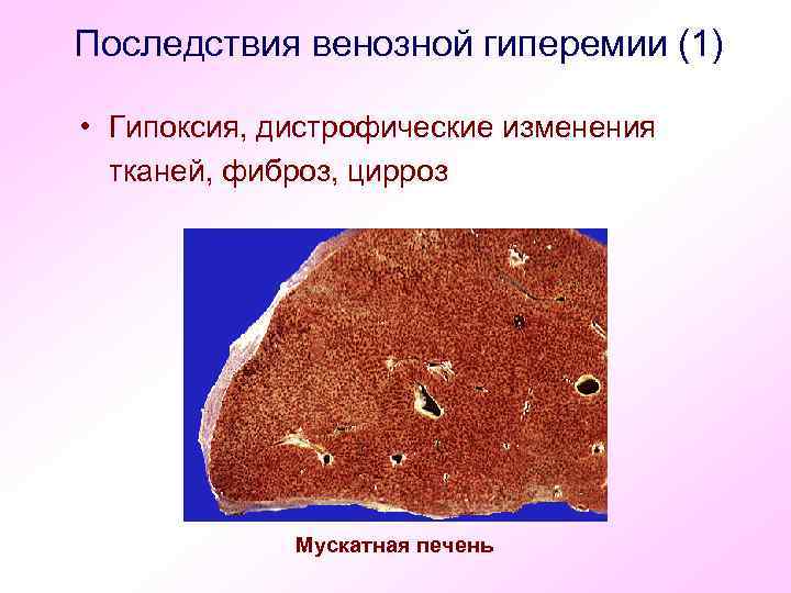 Последствия венозной гиперемии (1) • Гипоксия, дистрофические изменения тканей, фиброз, цирроз Мускатная печень 