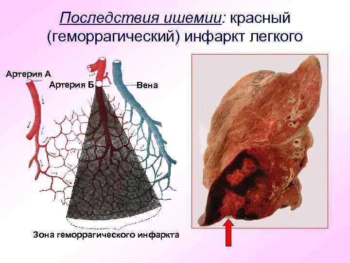 Последствия ишемии: красный (геморрагический) инфаркт легкого Артерия А Артерия Б Вена Зона геморрагического инфаркта