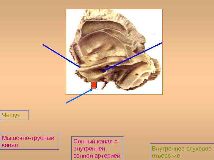 Сонный канал. Наружное отверстие сонного канала височной. Мышечно-трубный канал височной кости. Наружные отверстия сонных каналов. Сонный канал височной кости.