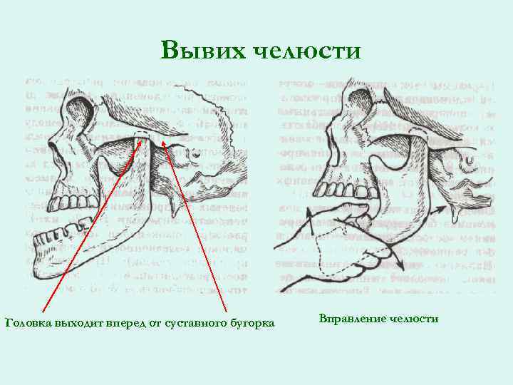 Вывих челюсти Головка выходит вперед от суставного бугорка Вправление челюсти 