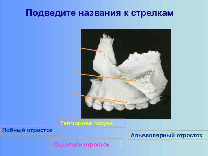 Подведите названия к стрелкам Гайморова пазуха. Лобный отросток Альвеолярный отросток Скуловой отросток 