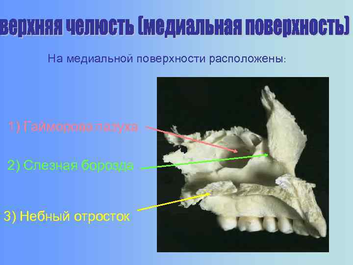 На медиальной поверхности расположены: 1) Гайморова пазуха 2) Слезная борозда 3) Небный отросток 