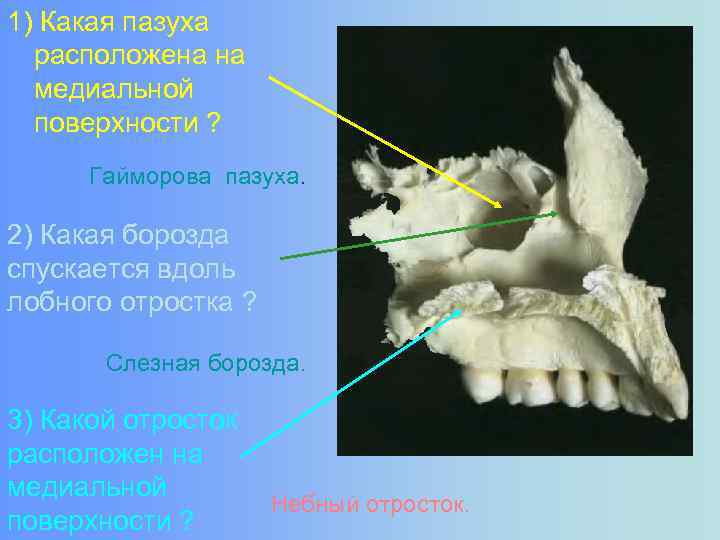 1) Какая пазуха расположена на медиальной поверхности ? Гайморова пазуха. 2) Какая борозда спускается