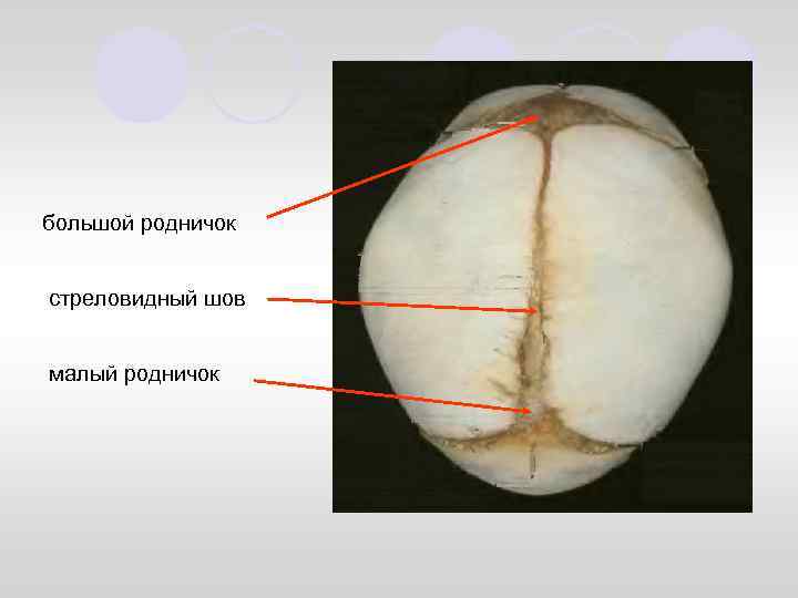 Большой родничок. Швы черепа стреловидный шов. Стреловидный шов у новорожденных. Швы черепа плода. Стреловидный шов черепа новорожденного.