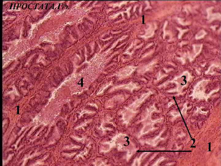ПРОСТАТА. Г/э. 1 3 4 1 3 2 1 