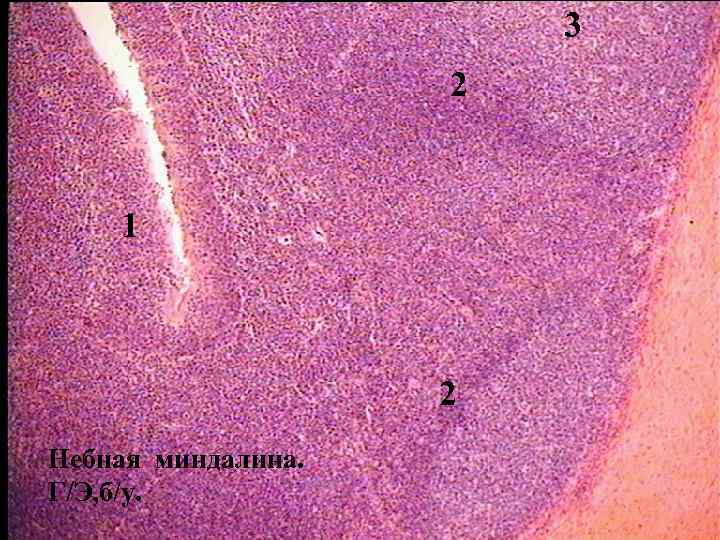 3 2 1 2 Небная миндалина. Г/Э, б/у. 