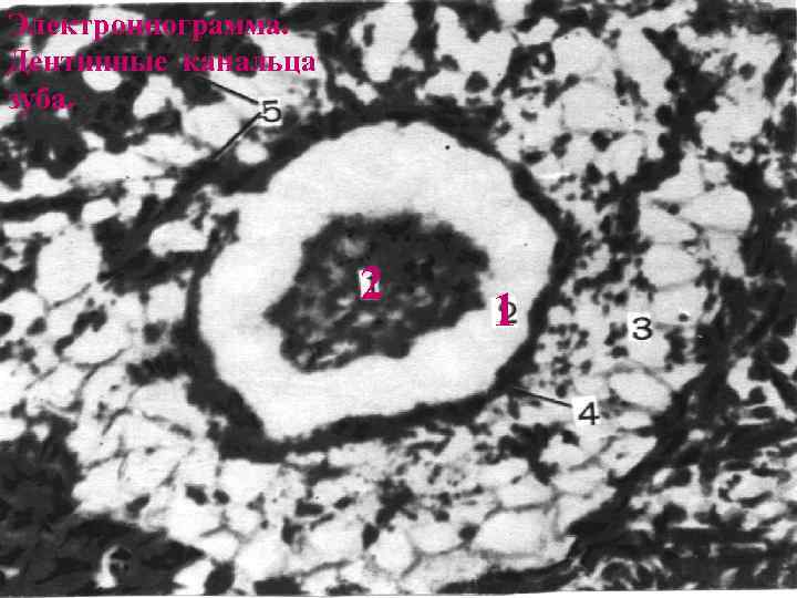 Электроннограмма. Дентинные канальца зуба. 2 1 