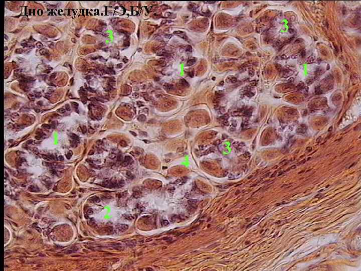 Дно желудка. Г/Э, Б/У. 3 3 1 1 4 2 1 3 