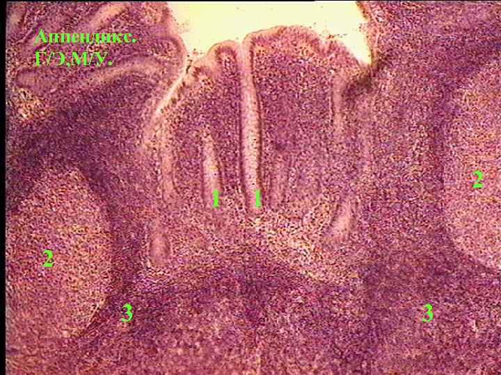 Аппендикс. Г/Э, М/У. 1 2 3 3 