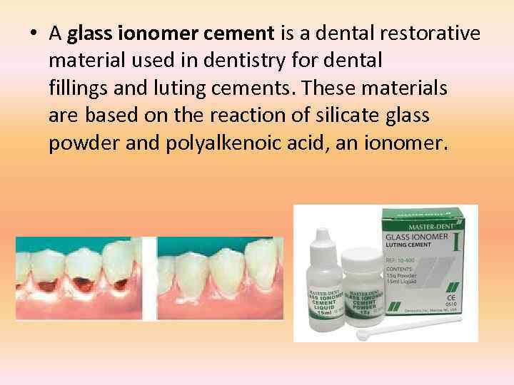  • A glass ionomer cement is a dental restorative material used in dentistry