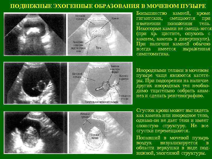 ПОДВИЖНЫЕ ЭХОГЕННЫЕ ОБРАЗОВАНИЯ В МОЧЕВОМ ПУЗЫРЕ Большинство камней, кроме гигантских, смещаются при изменении положения