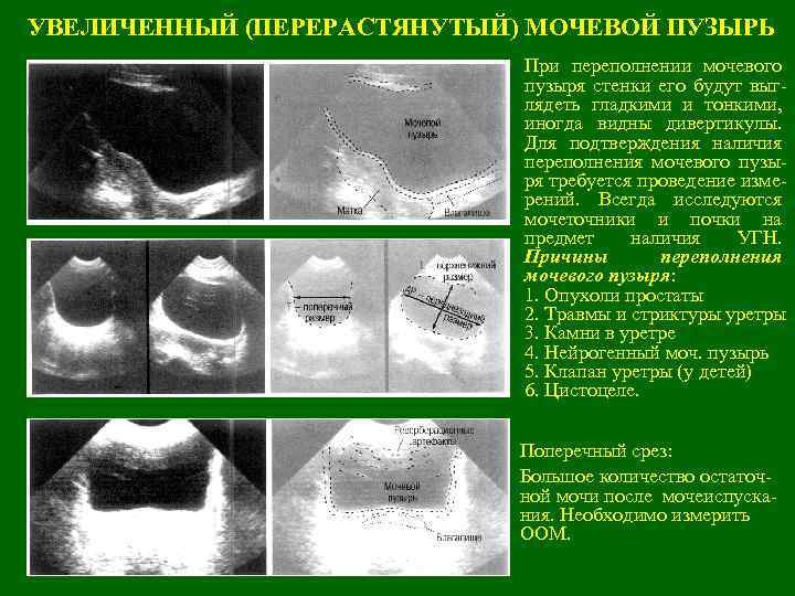 УВЕЛИЧЕННЫЙ (ПЕРЕРАСТЯНУТЫЙ) МОЧЕВОЙ ПУЗЫРЬ При переполнении мочевого пузыря стенки его будут выглядеть гладкими и
