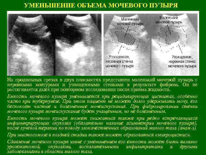 УМЕНЬШЕНИЕ ОБЪЕМА МОЧЕВОГО ПУЗЫРЯ На продольных срезах в двух плоскостях представлен маленький мочевой пузырь