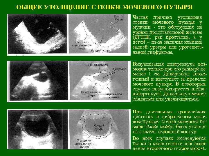 ОБЩЕЕ УТОЛЩЕНИЕ СТЕНКИ МОЧЕВОГО ПУЗЫРЯ Частая причина утолщения стенки мочевого пузыря у мужчин -