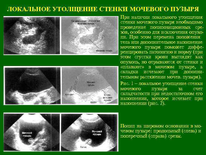 ЛОКАЛЬНОЕ УТОЛЩЕНИЕ СТЕНКИ МОЧЕВОГО ПУЗЫРЯ При наличии локального утолщения стенки мочевого пузыря необходимо проведение